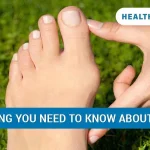 Everything You Need to Know About Bunions: Causes, Symptoms & Treatment