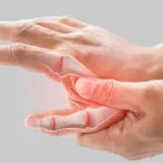 Erosive Osteoarthritis: A Comprehensive Guide